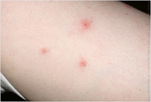 ind_photo_of_bedbug_bites.jpg